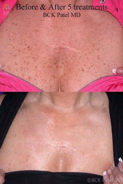 englishsurgeon.com Results of neck fotofacial treatments by Dr. BCK Patel MD, FRCS, Salt Lake City, St George