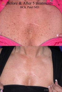 englishsurgeon.com. Photos showing improvment in the neck and chest sun-related changes