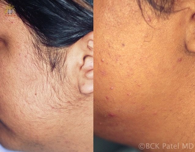 Illustrates before-and-after photos of laser hair removal by BCK Patel MD, FRCS