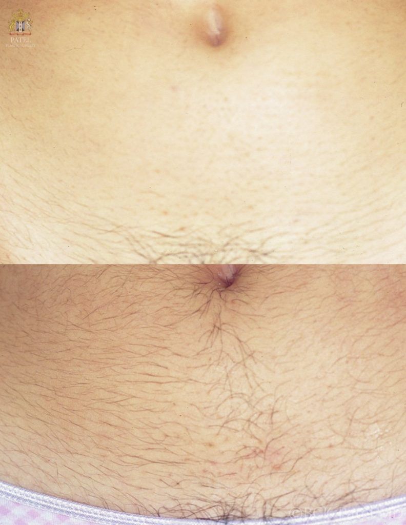 Laser hair removal from the abdomen by Dr. BCK Patel MD., Salt Lake City
