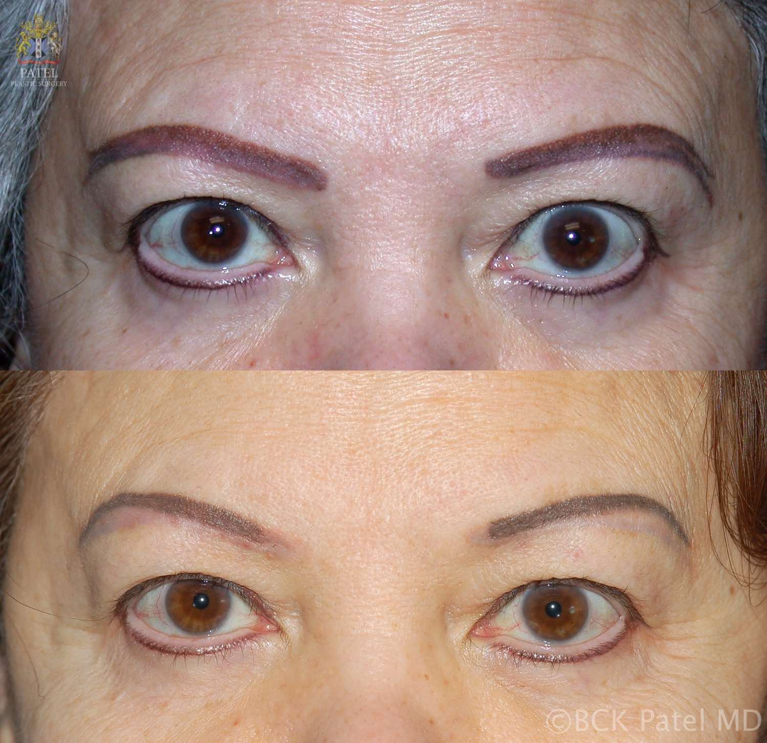 englishsurgeon.com. Photos showing a nice improvement in brow tattoos that were overdone. Lasers used. BCK Patel MD, FRCS, Salt Lake City, St George