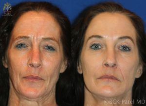 englishsurgeon.com. Photos showing improvement with botox injections. BCK Patel MD