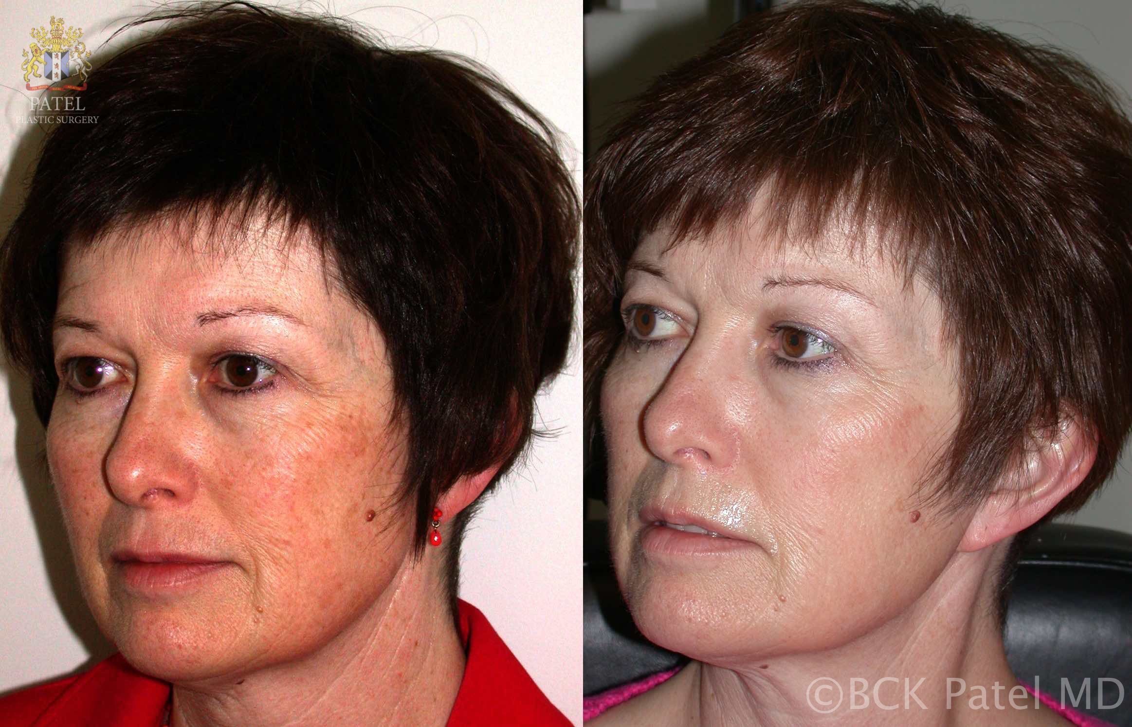 englishsurgeon.com. Results fo full face trichloroacetic acid chemical peels by Dr BCK Patel MD, FRCS, Salt Lake City, Utah, St George, London