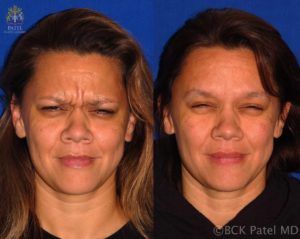 englishsurgeon.com. Photos showing the results of botox injections