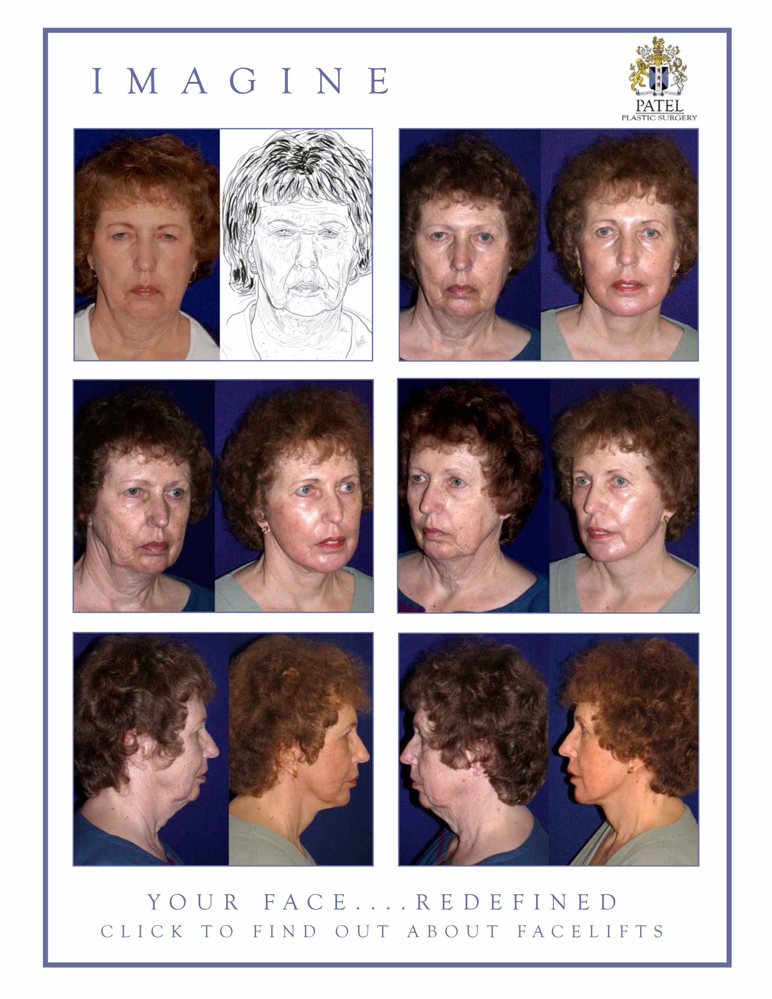 englishsurgeon.com Results of a facelift with fat grafts and the use of the CO2 laser on the face by Dr. BCK Patel MD, FRCS, Salt Lake city, Utah