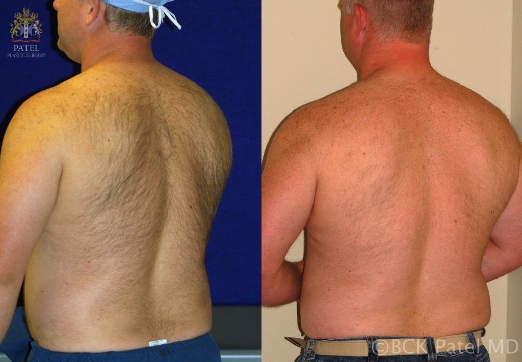 Laser hair removal back before and after photos by Dr. BCK Patel MD, FRCS, Salt Lake City, St. George