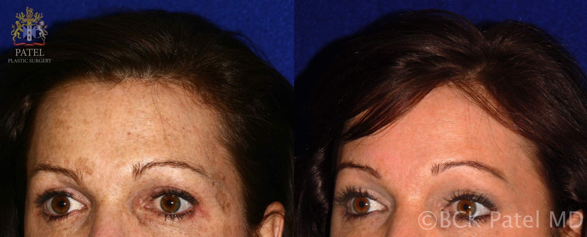englishsurgeon.com. Photos show before-and-after of advanced fotofacial laser treatments. BCK Patel MD, FRCS