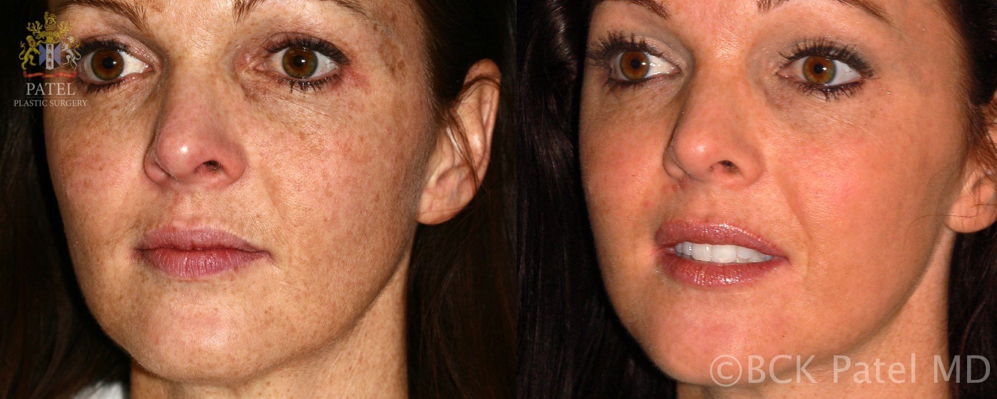 englishsurgeon.com Results of face fotofacial treatments by Dr. BCK Patel MD, FRCS, Salt Lake City, St George