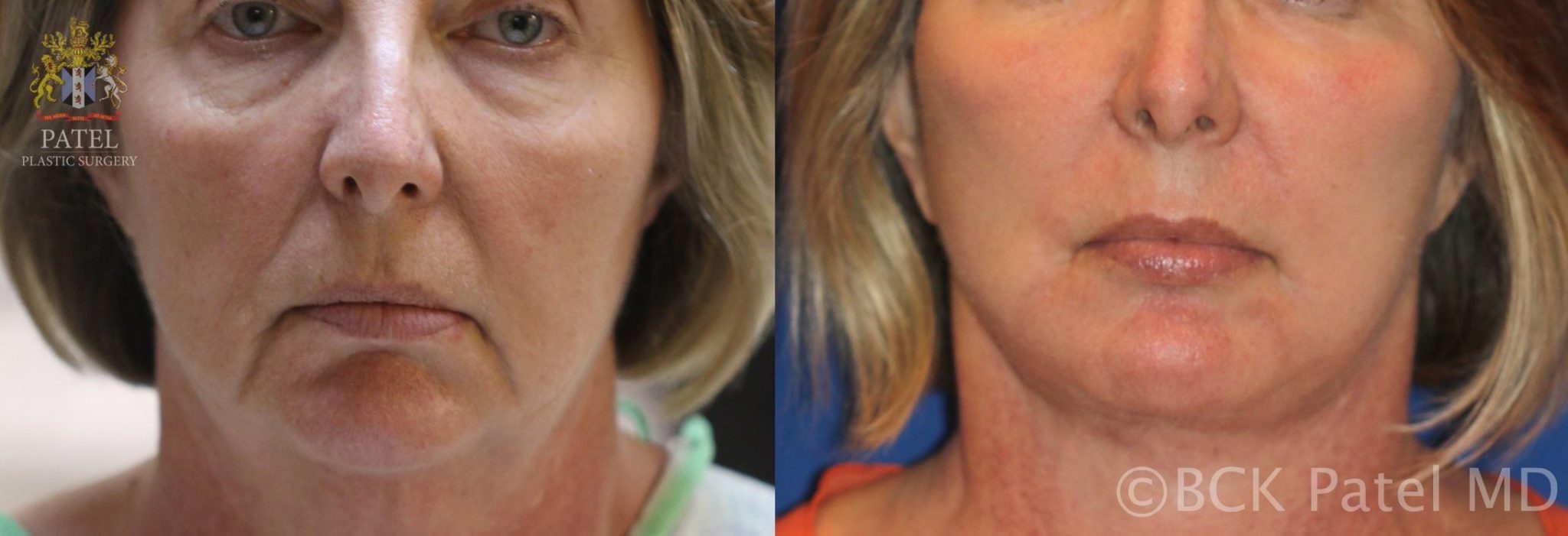 englishsurgeon.com. Photos show improvement in the upper lip length and lines as well as fullness by Dr. BCK Patel MD, FRCS, Salt Lake City, St George