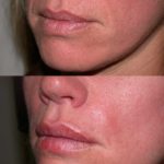 englishsurgeon.com. Photos showing fillers in lips with beautiful augmentation