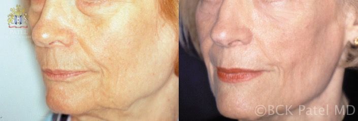 englishsurgeon.com. Photos show improvement in the upper lip length and lines as well as fullness by Dr. BCK Patel MD, FRCS, Salt Lake City, St George