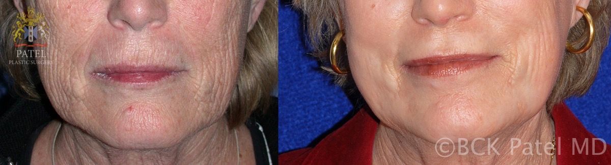 englishsurgeon.com. Photos showing the improvement of lines around the lips and on the face