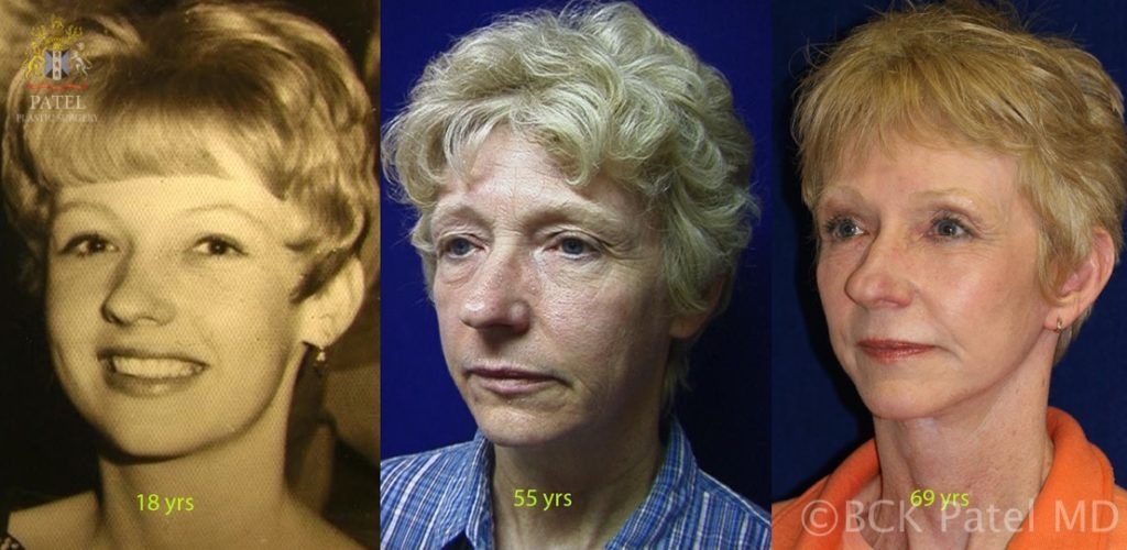 englishsurgeon.com. Photos showing the long-term results of the Patel Hammock lift together with browlifts, upper and lower blepharoplasty and skin grafts