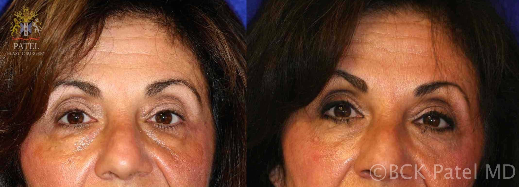 englishsurgeon.com. Photos showing improvement in lower eyelids and cheeks with fillers. BCK Patel MD, FRCS