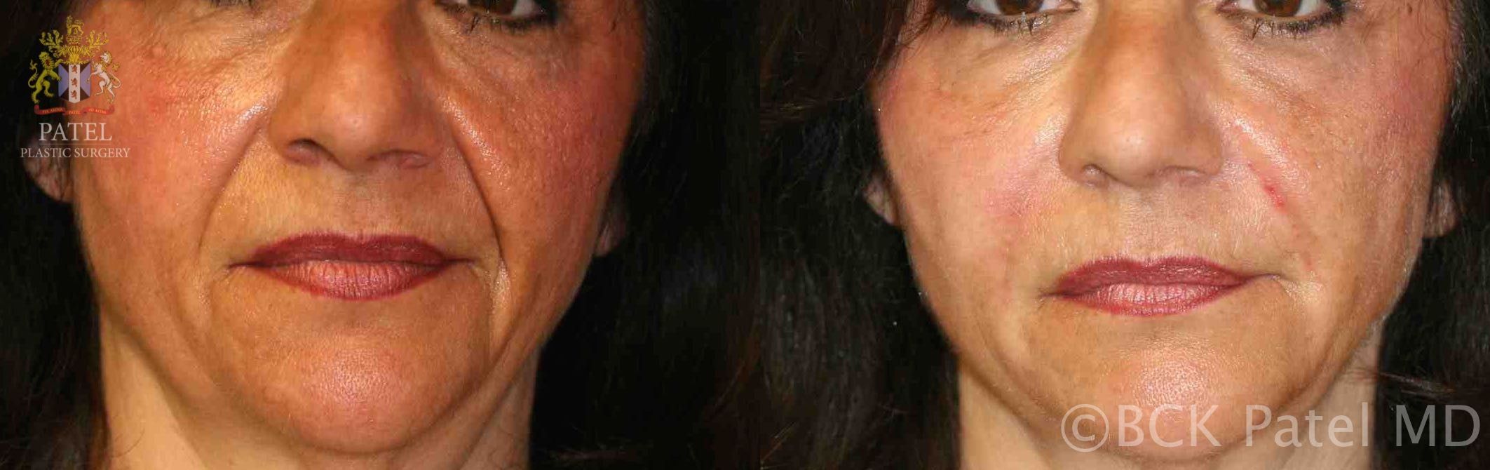 englishsurgeon.com. Photos showing improvement of the cheeks and nasolabail folds. BCK Patel MD