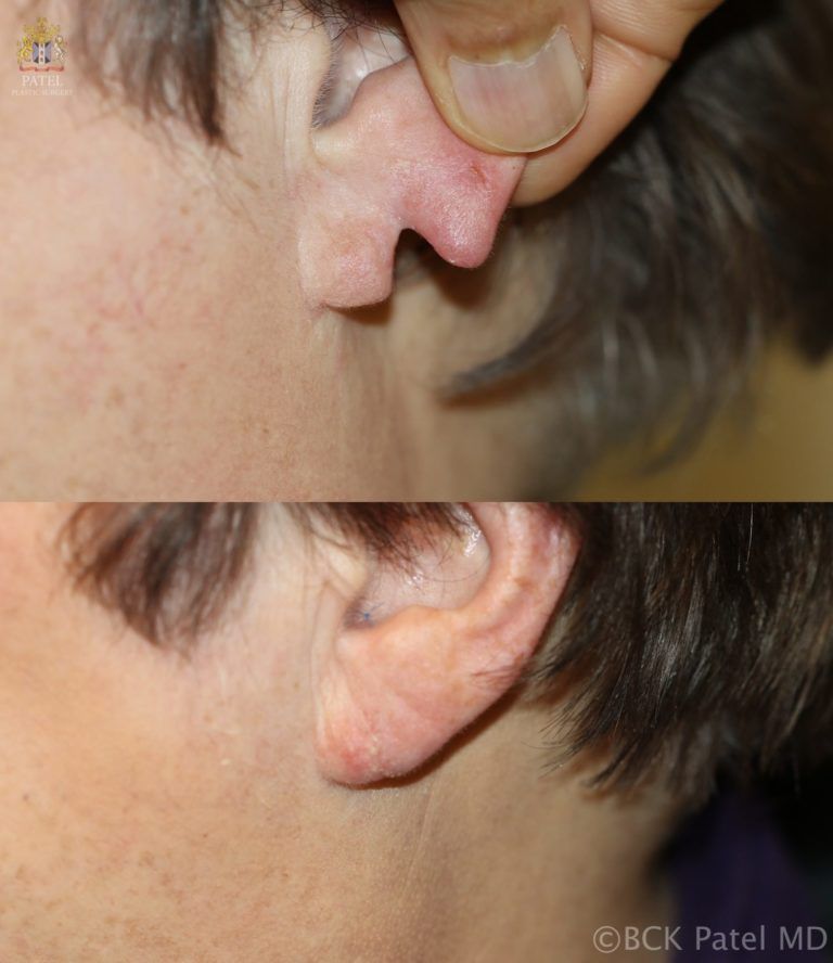 englishsurgeon.com Split earlobe repair by Dr. BCK Patel MD, FRCS, Salt Lake City, St. George
