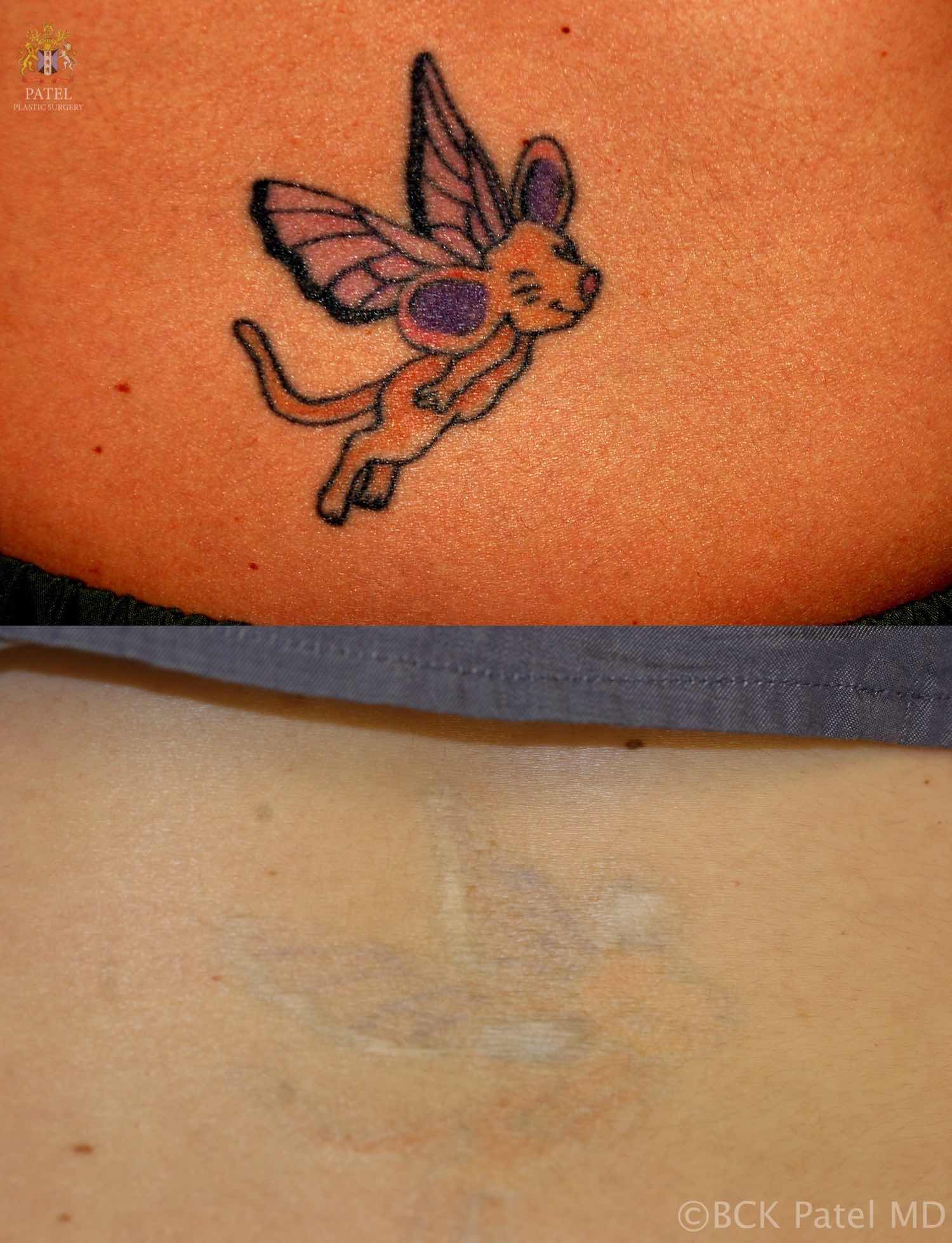 englishsurgeon.com. Photos showing the result of laser tattoo removal. Sometimes a slight lightness of the skin occurs. BCK Patel MD, FRCS, Salt Lake City