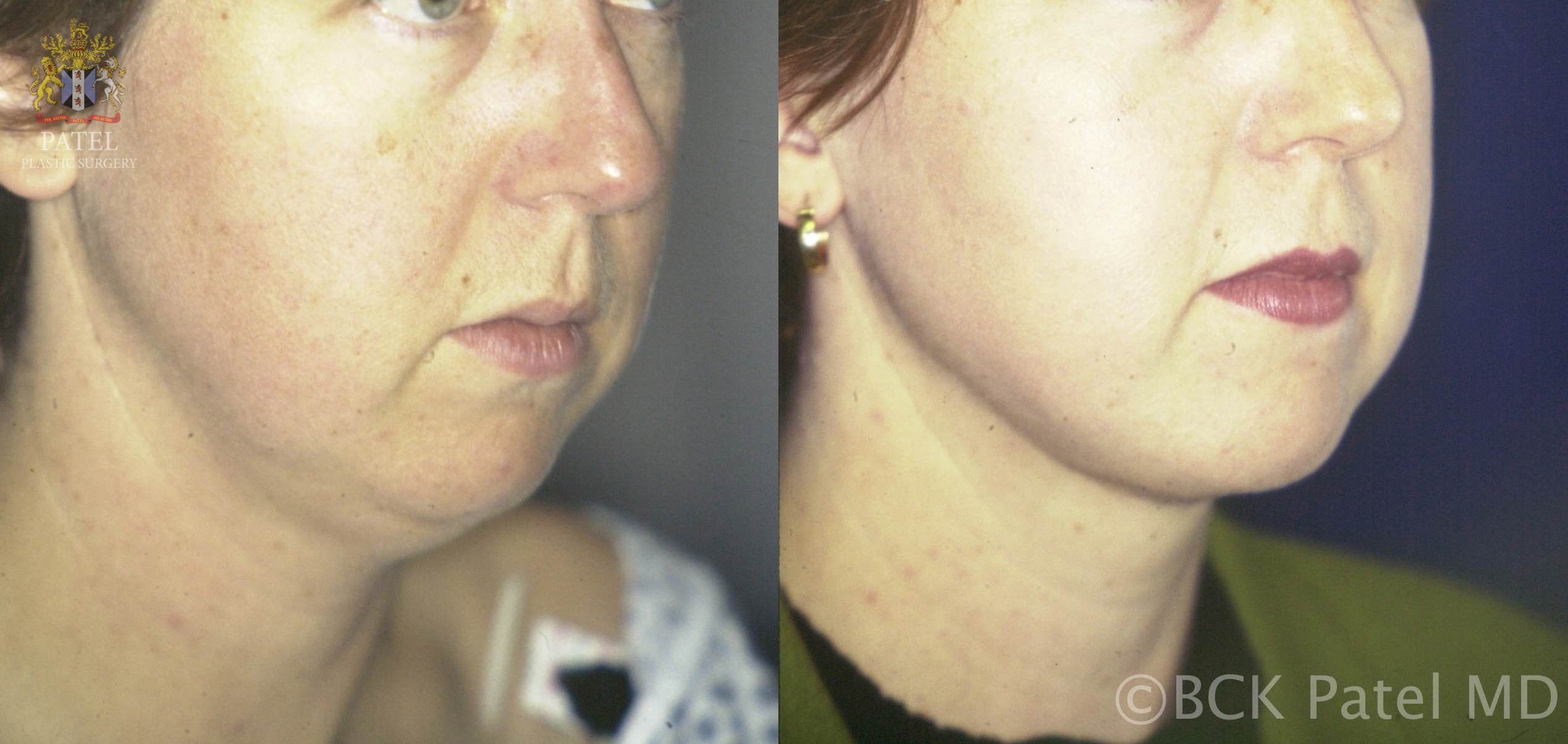 englishsurgeon.com Results of Vaser neck liposuction in Salt Lake City by Dr. BCK Patel MD, FRCS and St. George