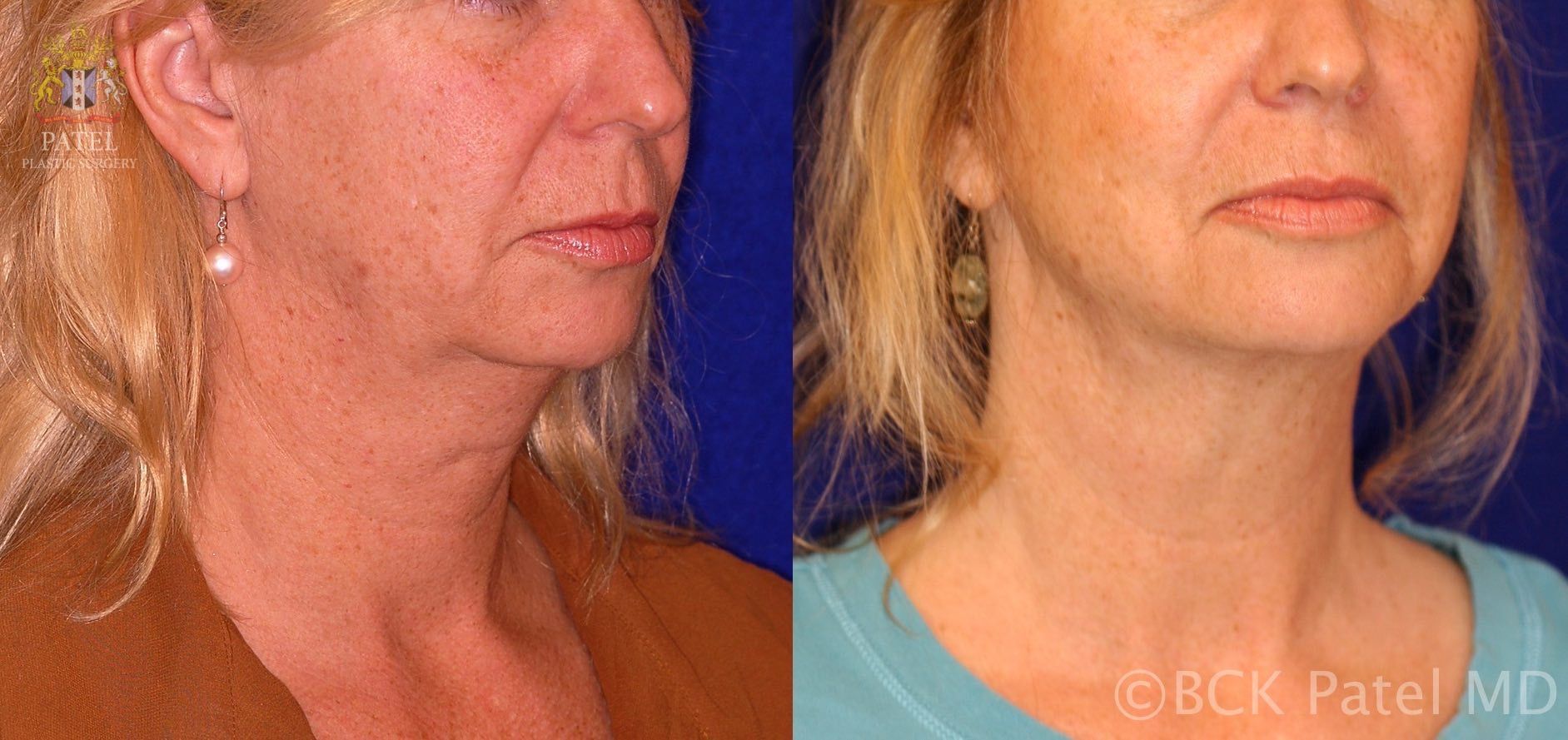 englishsurgeon.com Results of Vaser neck liposuction in Salt Lake City by Dr. BCK Patel MD, FRCS and St. George