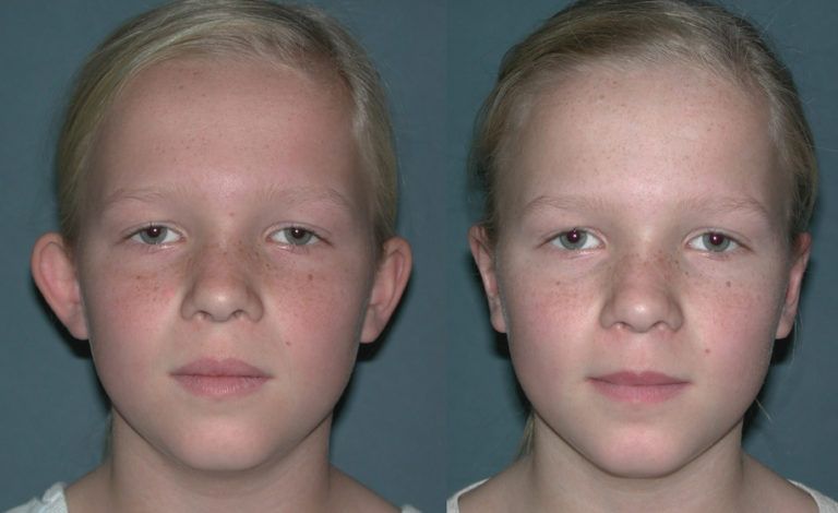 englishsurgeon.com Photos show how otoplasty (bat-ear surgery) may be performed to improve the appearance of the ears. BCK Patel MD, FRCS, Salt Lake City, Utah, St. George