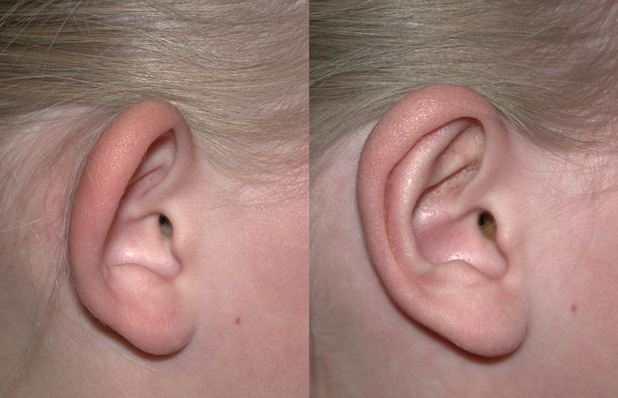 Repair Of Bat Ears Otoplasty And Holes In Ears And Earlobe Tears