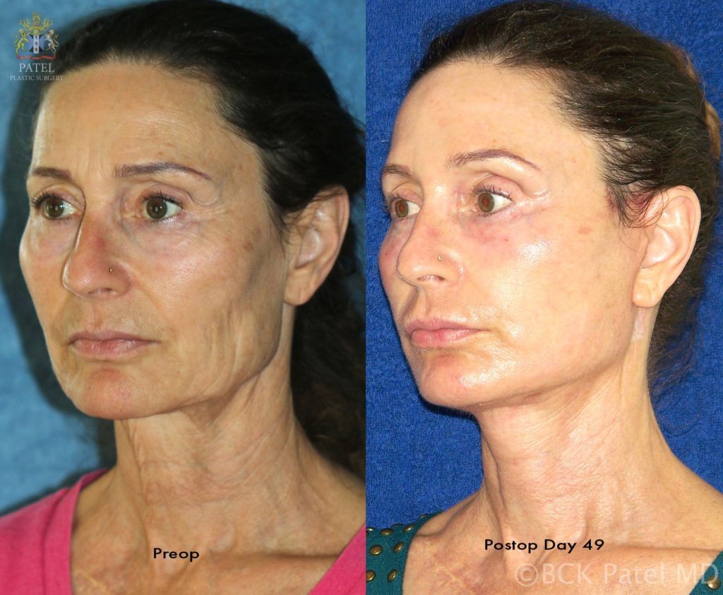 englishsurgeon.com. Photos show results of a facelift and necklift in a female with a tight jawline and neck. BCK Patel MD, FRCS; Salt Lake City, Utah