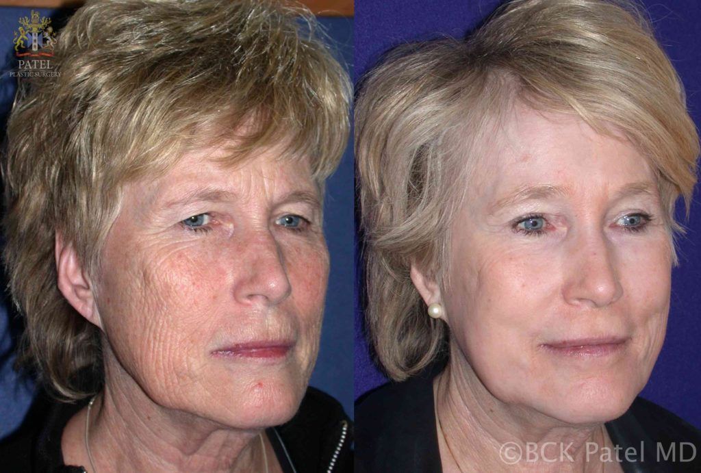 englishsurgeon.com. Long-term followup of the full face after fractionated CO2 laser treatment by Dr. BCK Patel MD, FRCS, Salt Lake City, London, St George
