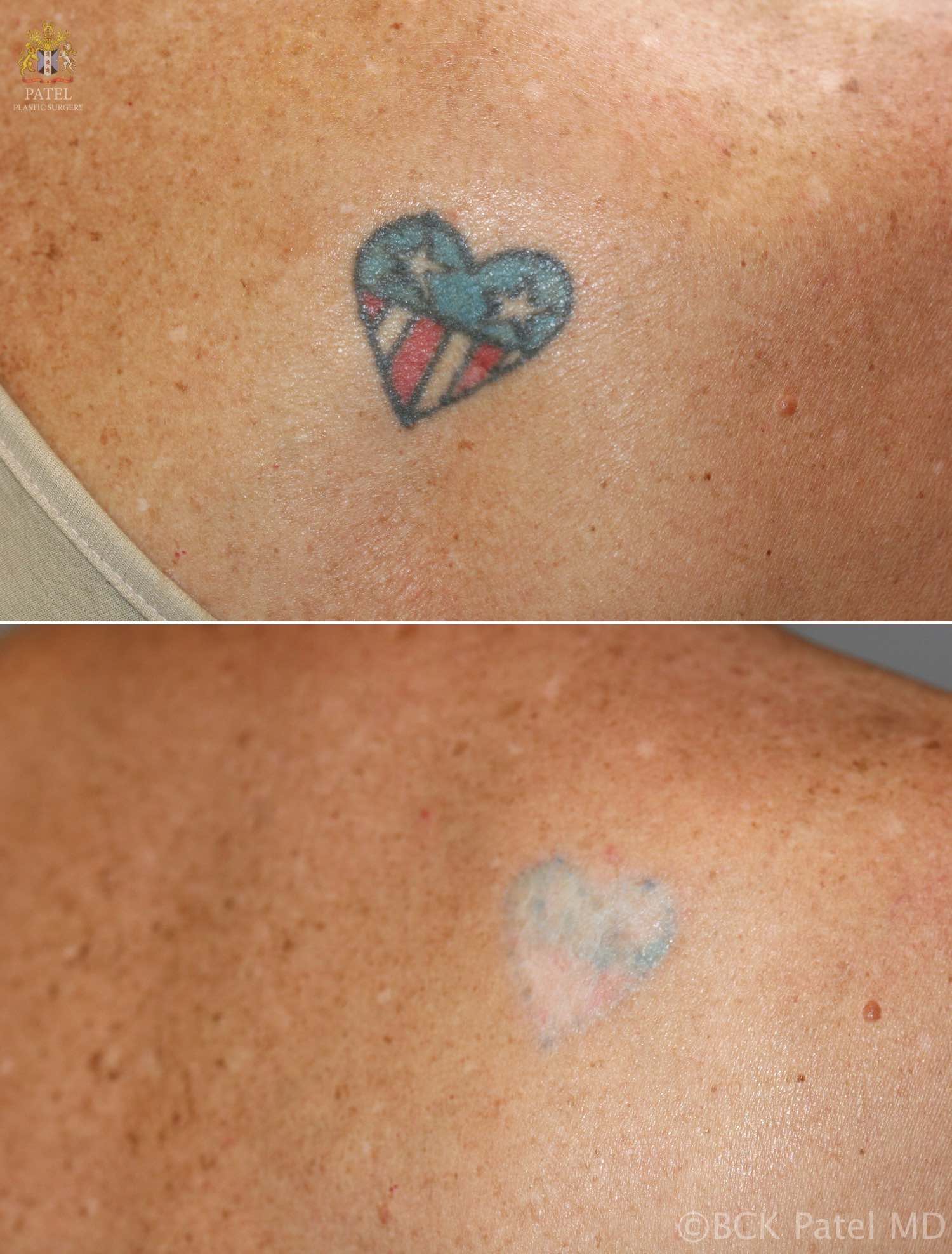 Tattoo Removal: How It Works, Process, Healing & Scarring