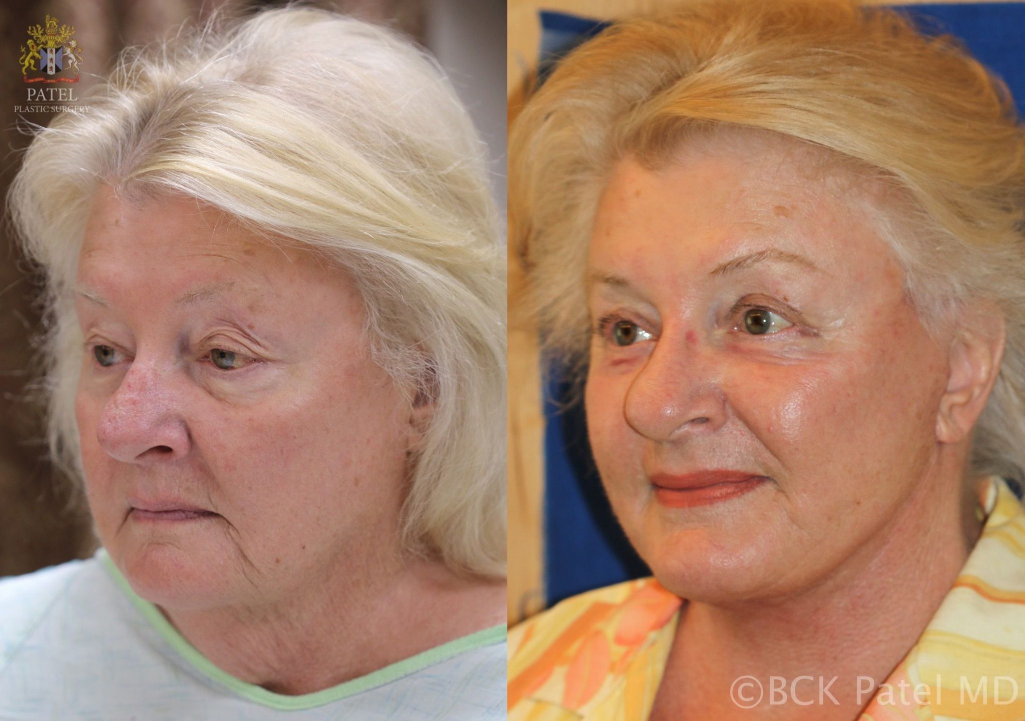 englishsurgeon.com. Photos show results of a facelift and necklift in a female with a tight jawline and neck. BCK Patel MD, FRCS; Salt Lake City, Utah
