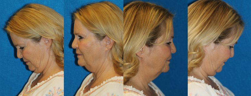 englishsurgeon.com. Photos show how to take photos of your face with looking straight ahead, sideways and with the chin down. Sequence of photographs demonstrated in this series.