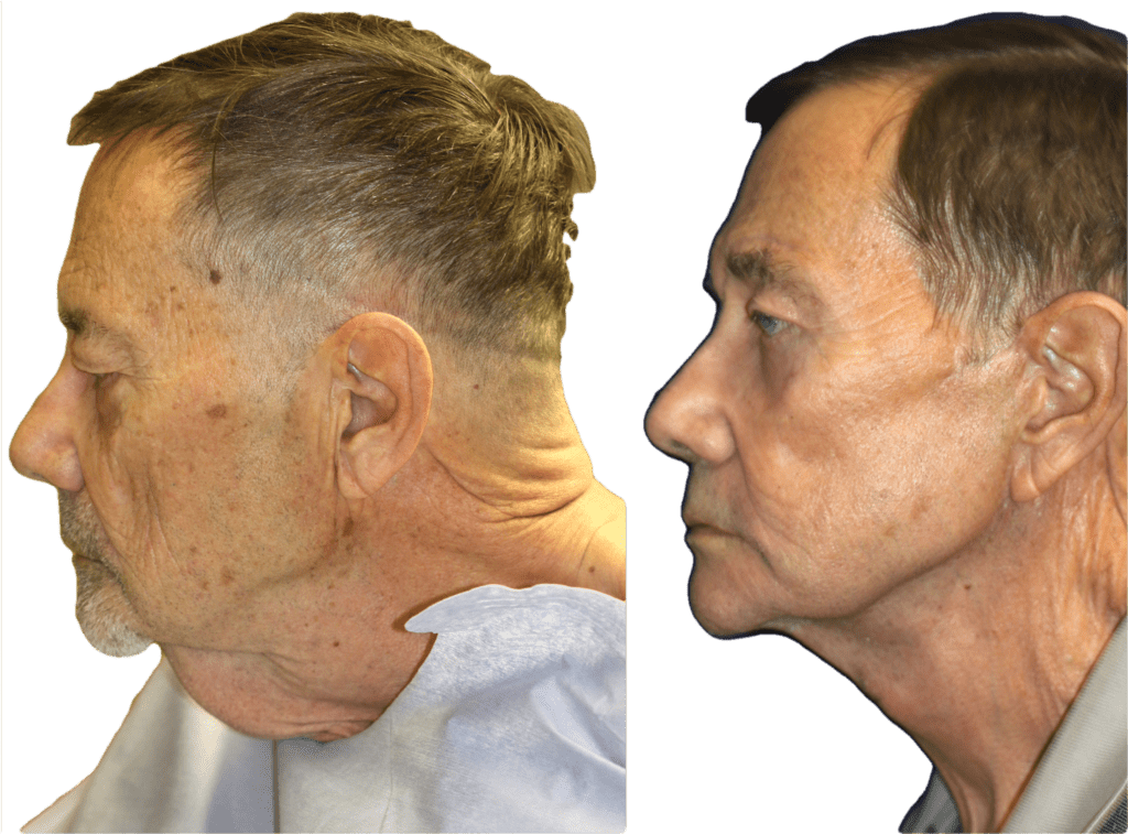 Photos show the results of performing a facelift and necklift in a man after massive weight loss. BCK Patel MD, FRCS