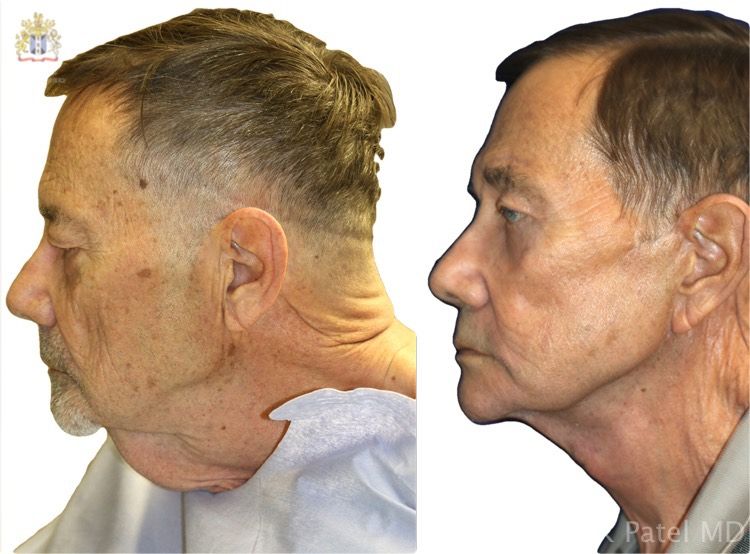 englishsurgeon.com. Before and after photographs of a male facelift and necklift
