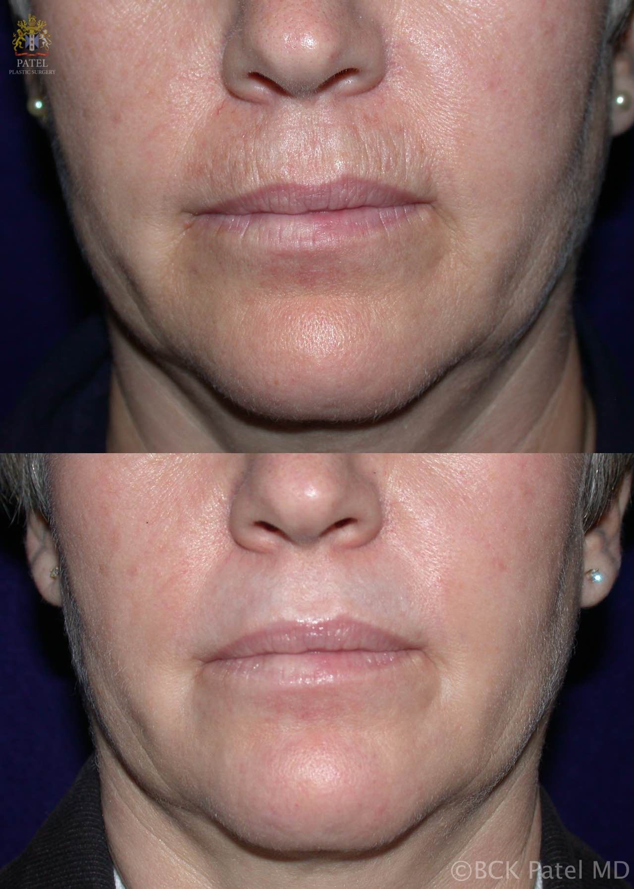 Nice improvement in the smoker's lines around the mouth, marionette lines after CO2 laser by Dr. BCK Patel MD, FRCS, Salt Lake City, London, St George