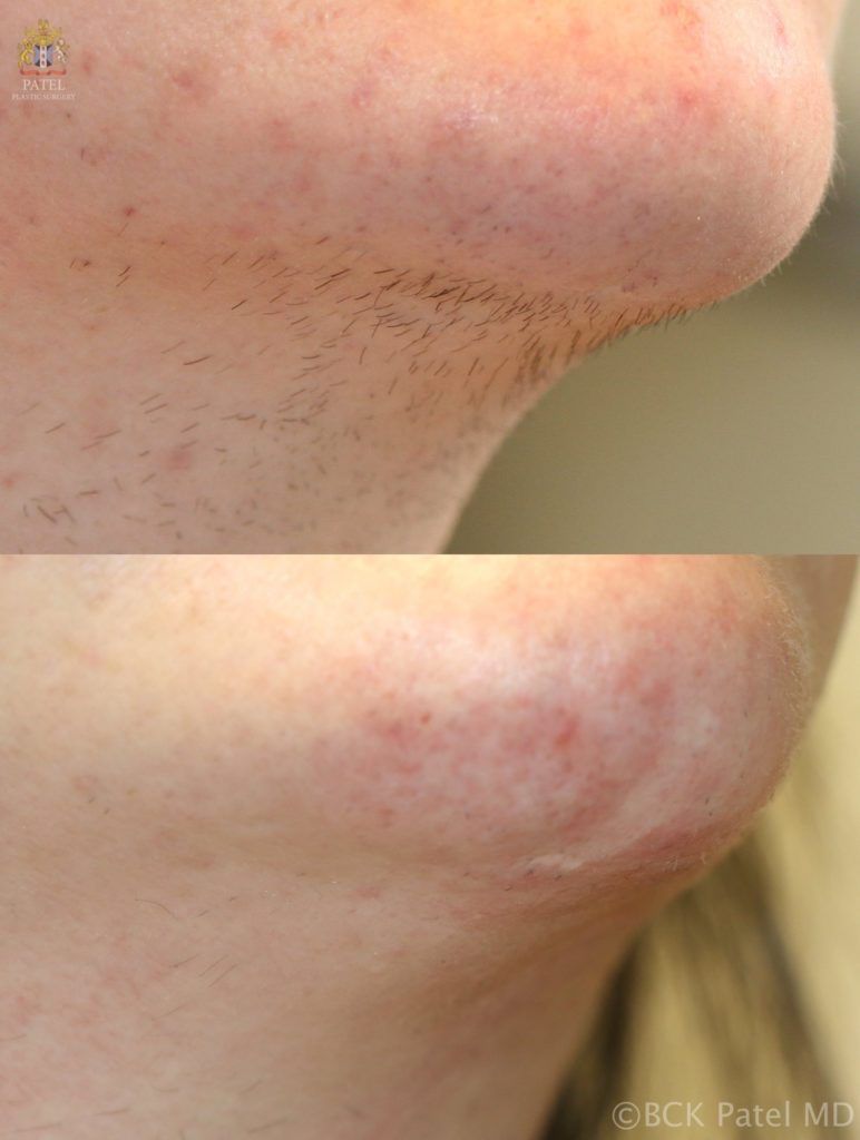 Laser hair removal from the chin and neck of a female By BCK Patel MD, FRCS, Salt Lake City, St. George
