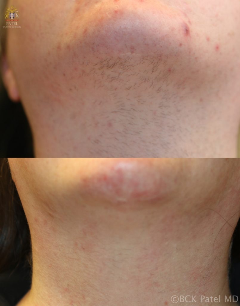 Laser hair removal from the chin and neck of a female By BCK Patel MD, FRCS, Salt Lake City, St. George