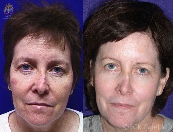 Photos show beautiful result with CO2 laser treatment of the full face by Dr. BCK Patel MD, FRCS, London, Salt Lake City, St. George