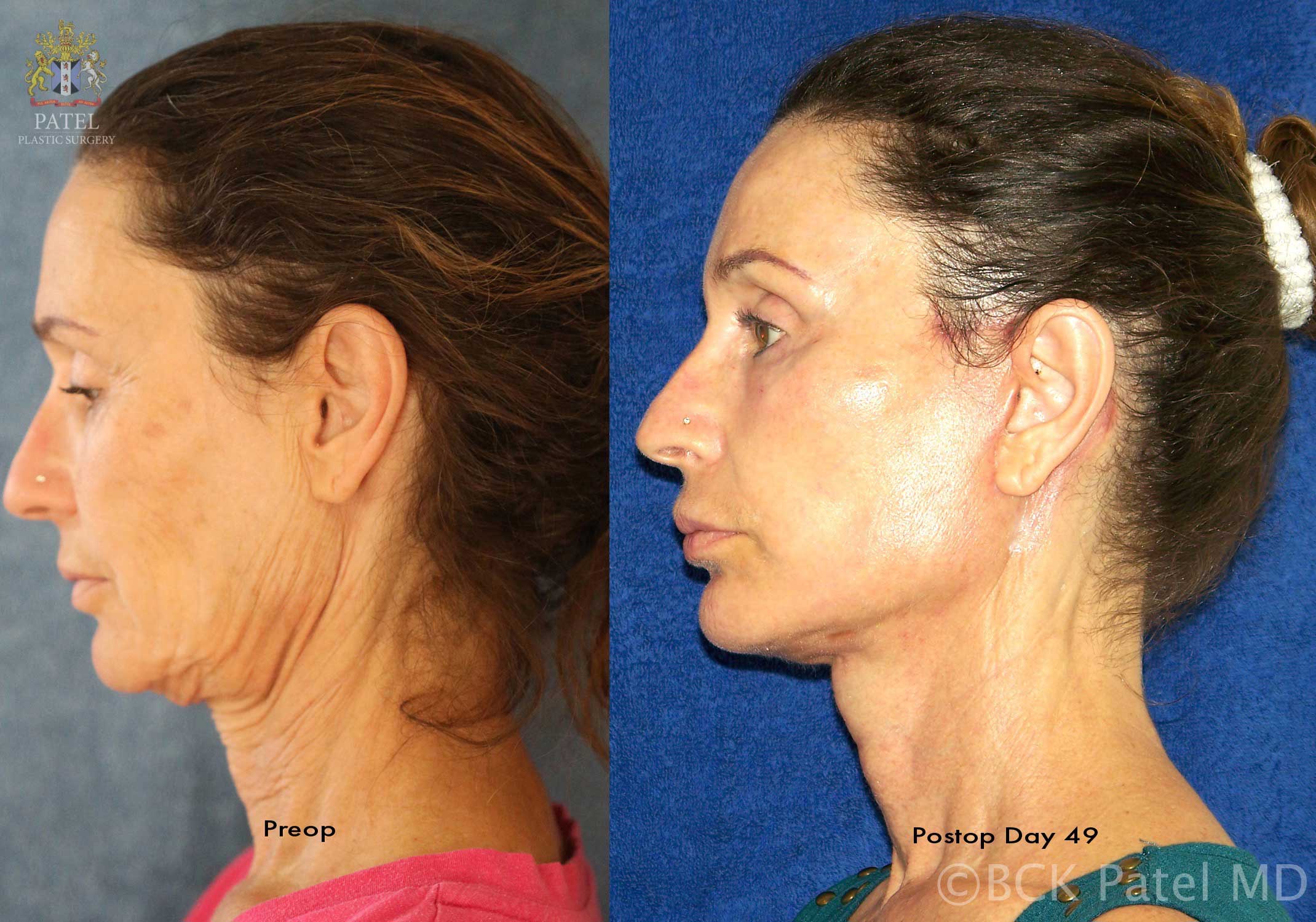 Results of a facelift and necklift 49 days after surgery performed by Dr. Bhupendra Patel of Salt Lake City, Saint George and London, England