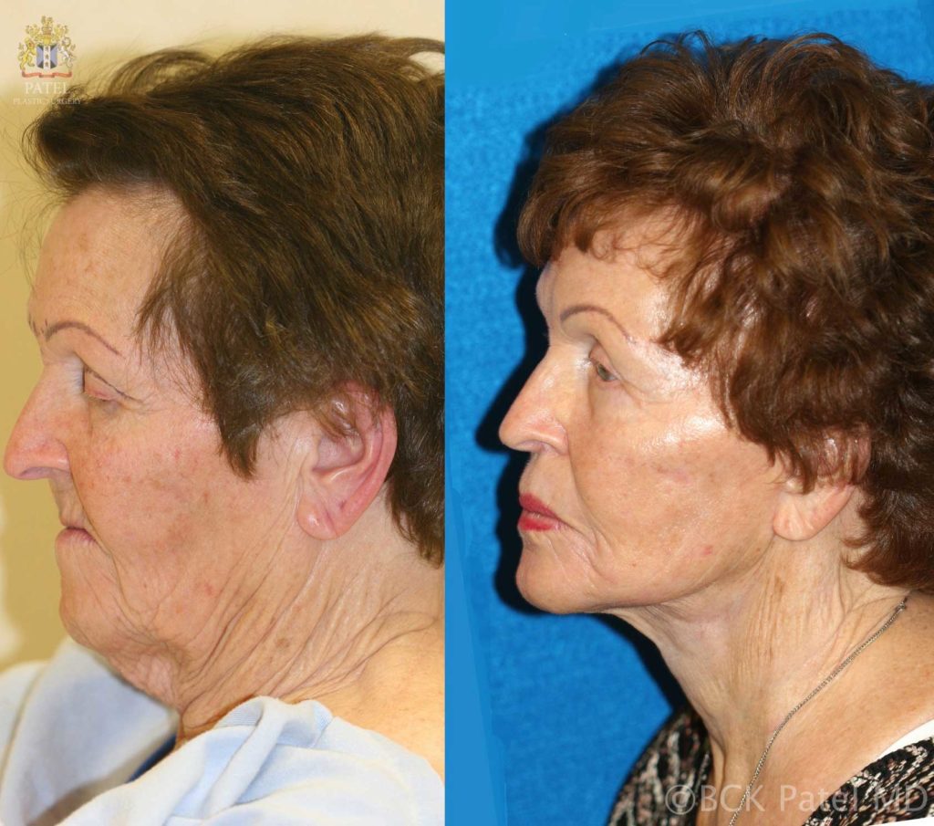 Dr. Bhupendra Patel Md of Salt Lake City, Saint George and London, England performs a facelift and necklift with fat grafts in Salt Lake City, Saint George and London, England