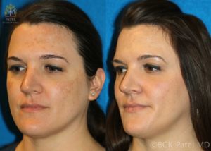 Before and after photos of results of treating melasma with a chemical peel by Dr. BCK Patel MD, FRCS of Salt Lake City, Utah and St. George