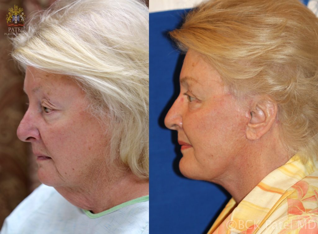Facelift and necklift by Dr. BCK Patel (Bhupendra Patel) of Salt Lake City, Saint George, and London, England