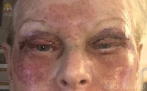 CO2 laser treatment with upper and lower blepharoplasty and fat grafts by Dr. Bhupendra C. K. Patel MD of Salt Lake City, St. George, London, England