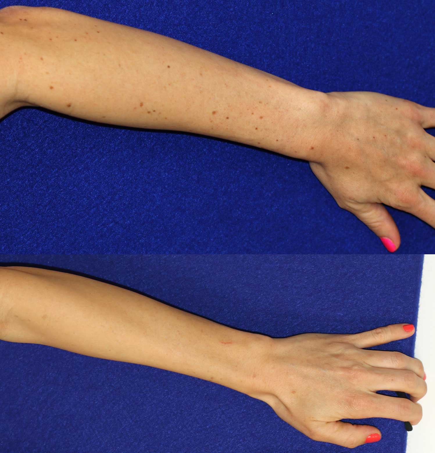 Laser treatment to arm and hand spots