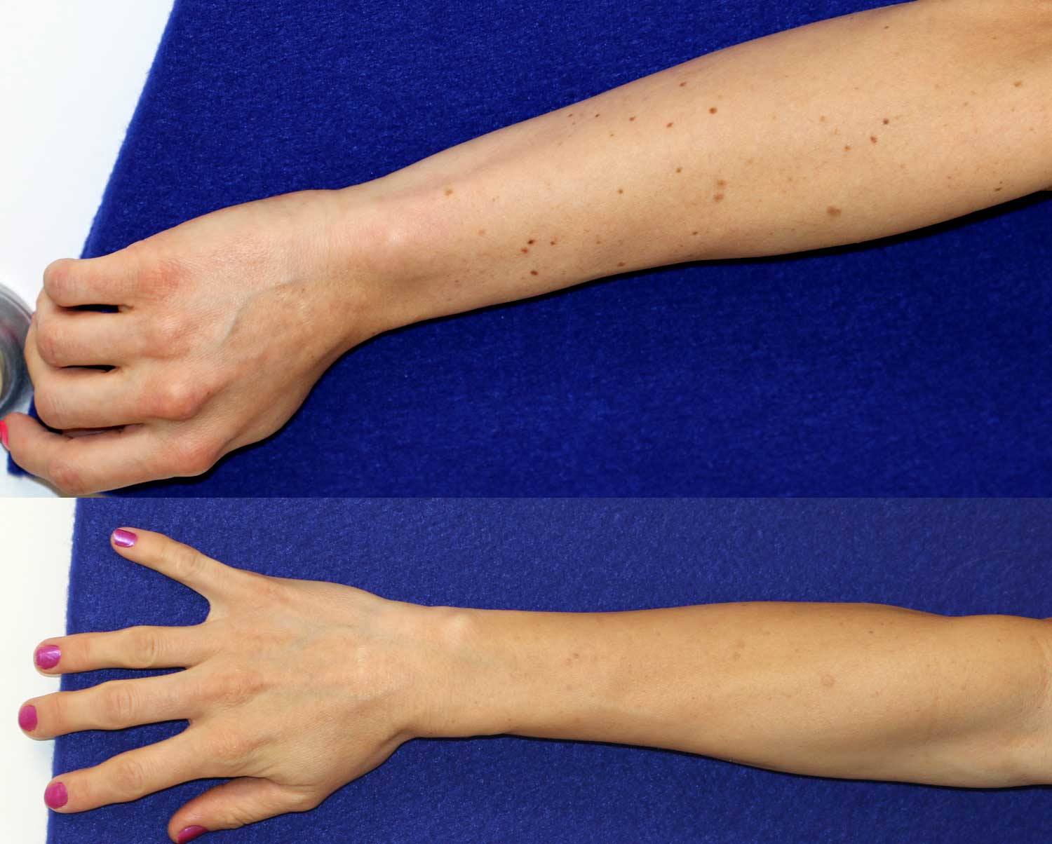 Results of laser treatment to arm and hand spots