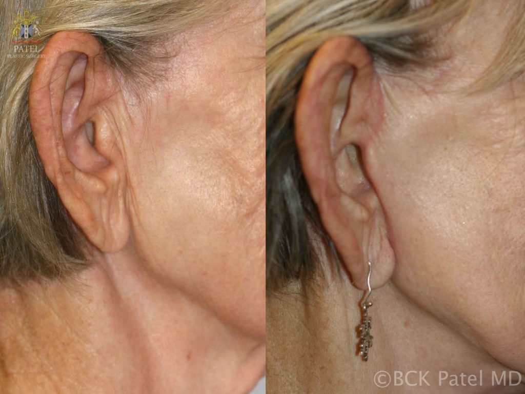 Photos of the right preauricular incisions after a facelift