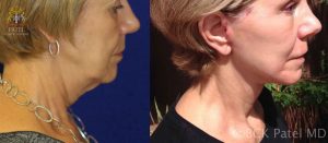 Facelift before-and-after by Dr. Bhupendra Patel MD of Salt Lake City and Saint George Utah