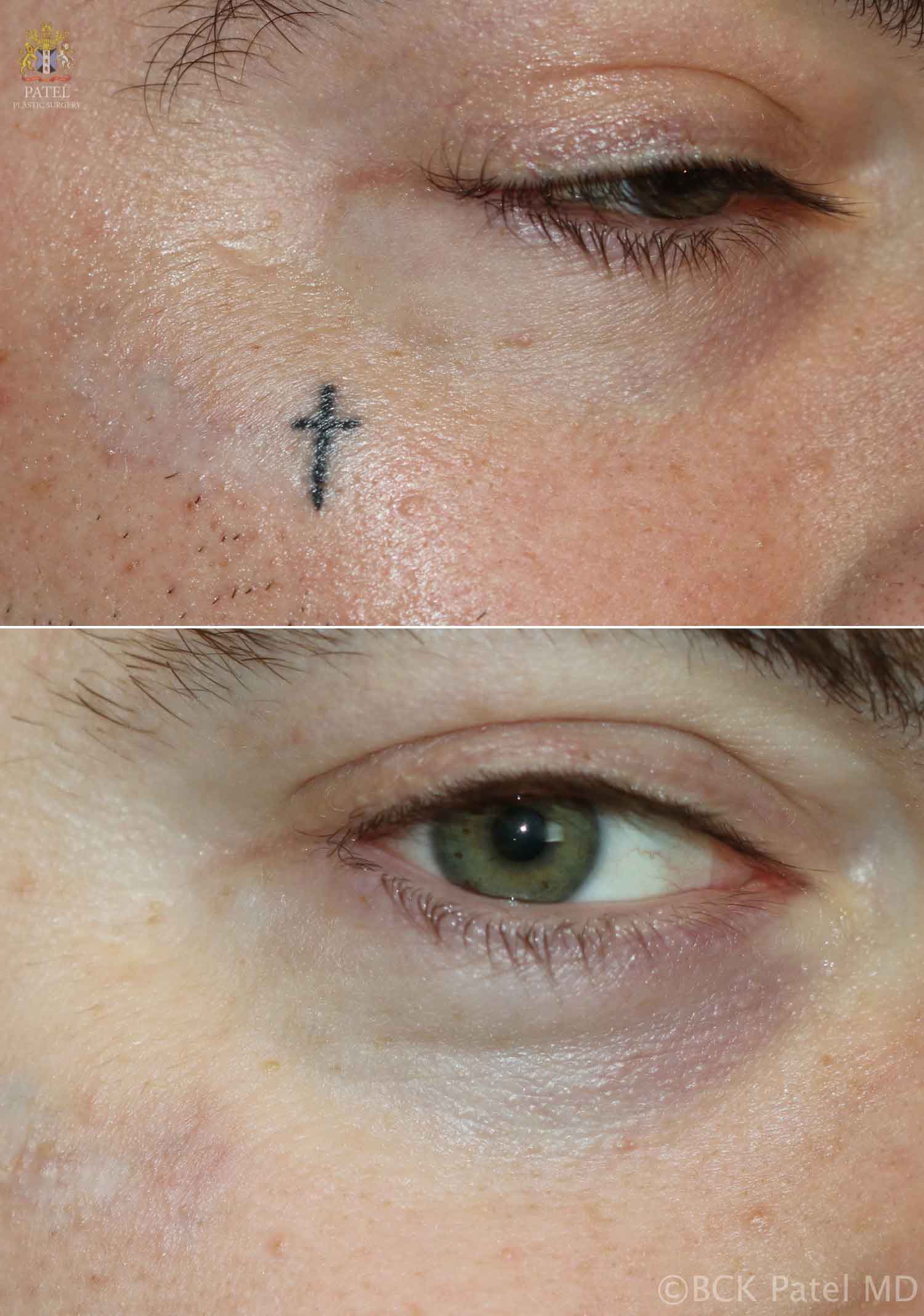 Laser removal of a dark tattoo by Dr. Bhupendra Patel