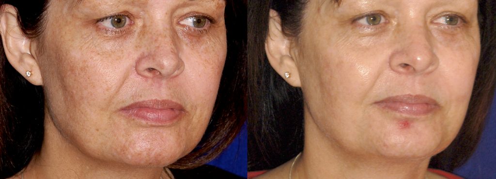Improvement in skin tone and tightness with picosecond lasers