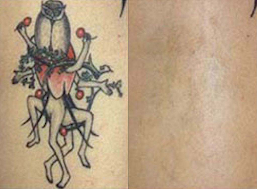 Tattoo removal with picosecond laser by Dr. BCK Patel MD