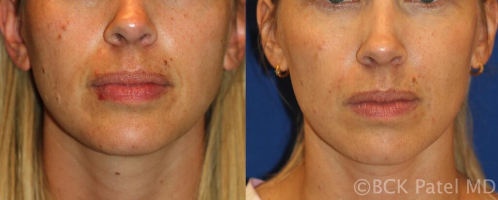 Reduction of Moles on the face before a Wedding! We preserved the "beauty moles" according to the patient's wishes, leaving a very clean and attractive face. By Dr BCK Patel MD, FRCS of Salt Lake City and St. George Utah