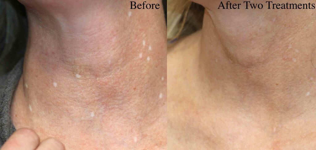 Removal of white scars left after mole removal. This is after two laser treatments by Dr. BCK Patel MD, FRCS of Salt Lake City and St. George Utah. Mole removal with minimal scars by Dr Patel in Salt Lake City and St. George, Utah